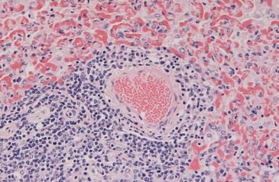 Възпаление