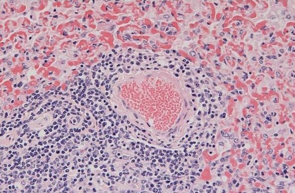 Възпаление